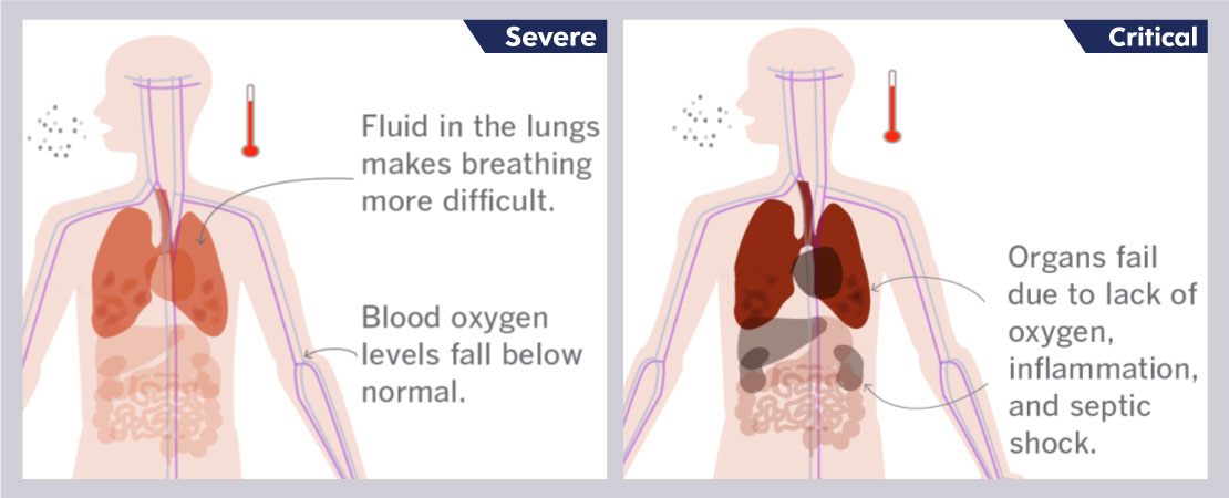 The virus affects the human lungs leaving them incapable of performing the gaseous transport at its maximum potential.